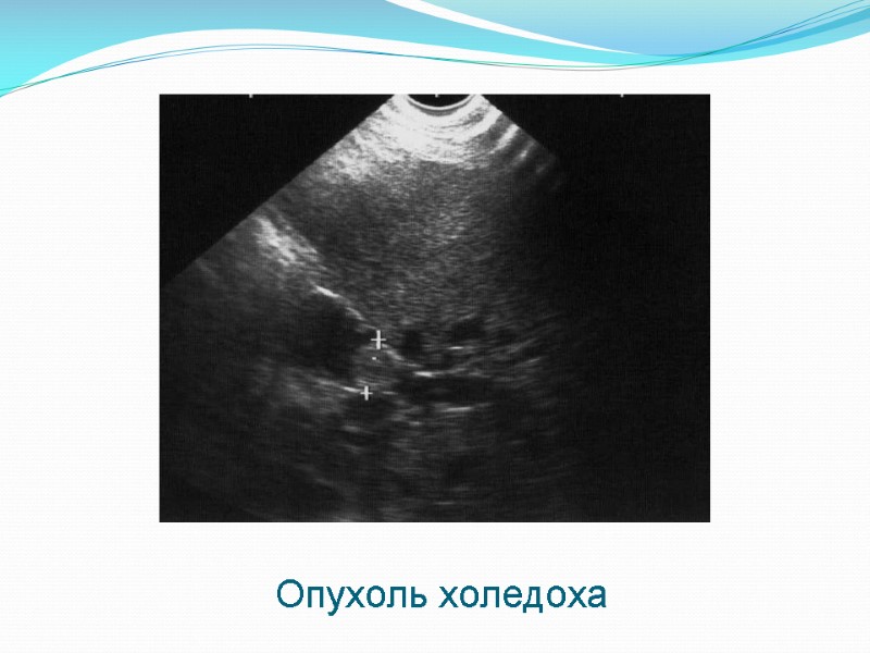 Опухоль холедоха